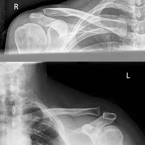 X-ray Clavicle Both AP